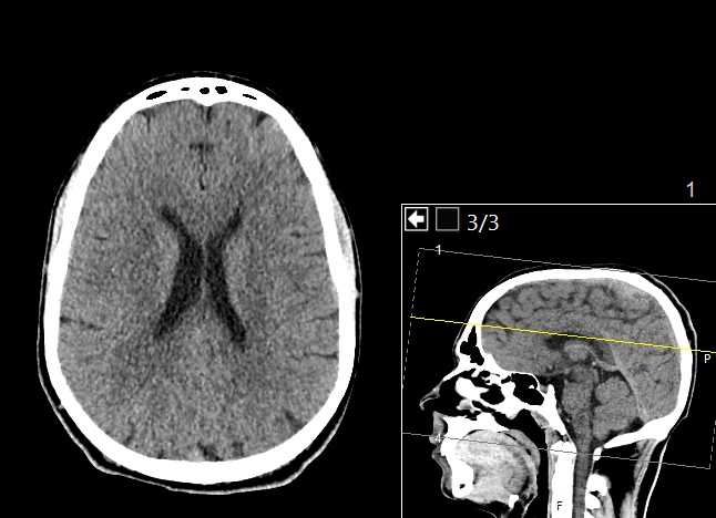Axial noncontrast head CT with a sagittal locator, from a source series described as normal. Dense skull and darker brain tissue illustrate CT attenuation differences.