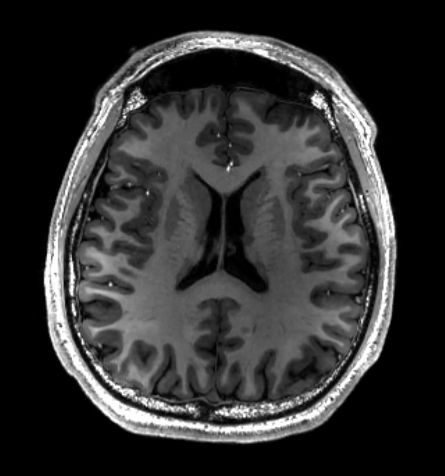 Axial T1-weighted brain MRI acquired at 7 Tesla. This independent example shows dark ventricular fluid and gray–white matter contrast; it is not paired with the T2 example.
