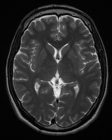 Axial T2-weighted brain MRI at the lateral ventricles. Ventricular fluid is bright. This is a different source study and slice level from the T1 example.