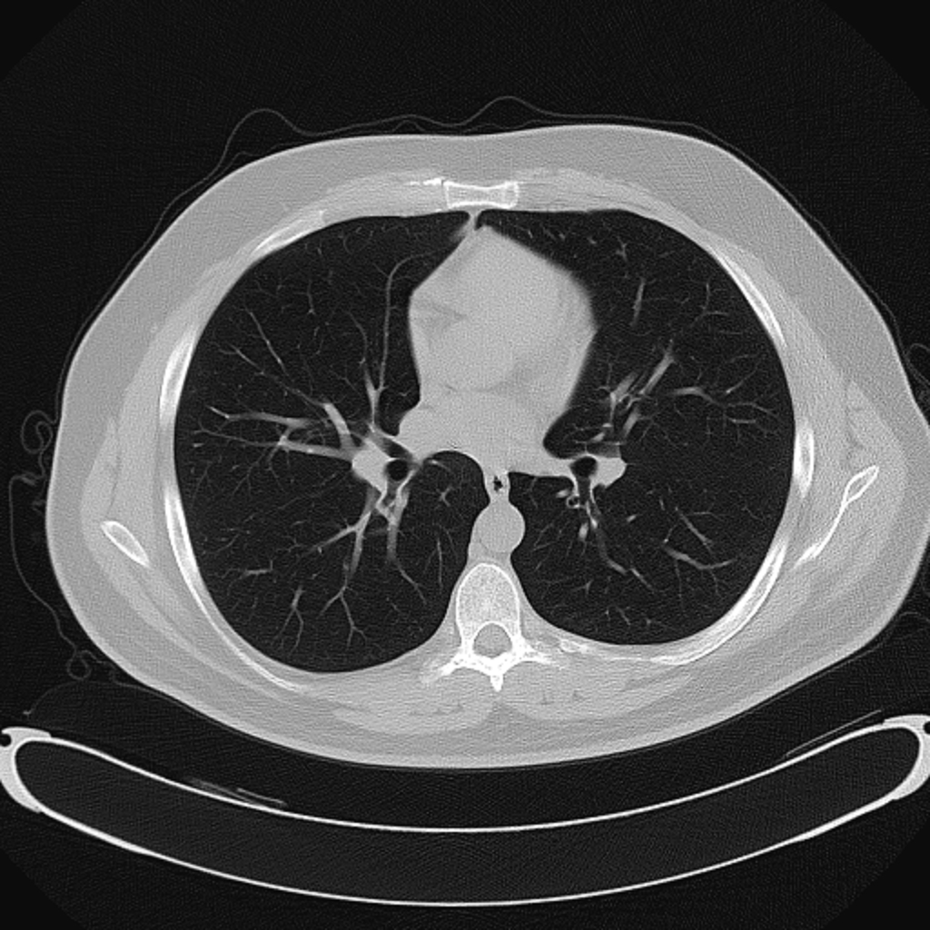 An axial chest CT displayed in a lung window, showing branching pulmonary vessels against air-filled lungs. This is a fixed display image, not raw CT data; it cannot support true Hounsfield-unit windowing.