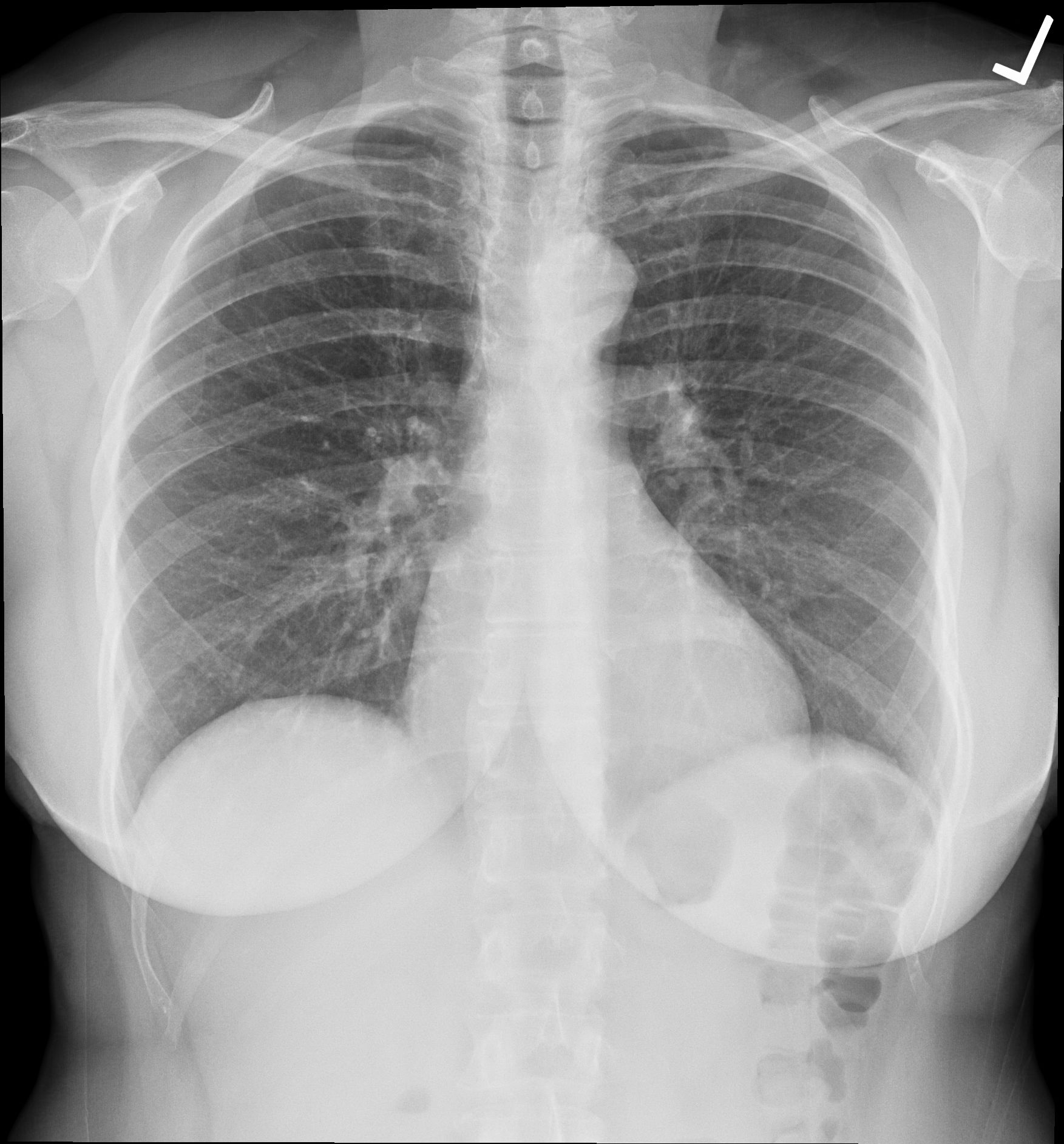 Frontal chest radiograph showing the lungs, cardiac silhouette and ribs. The source identifies this as a normal digitally acquired chest radiograph.