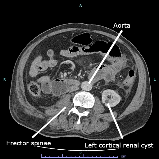 Axial abdominal CT with a left renal cortical cyst identified by the source. This is a pathology example, not a normal counterpart to the ultrasound image.