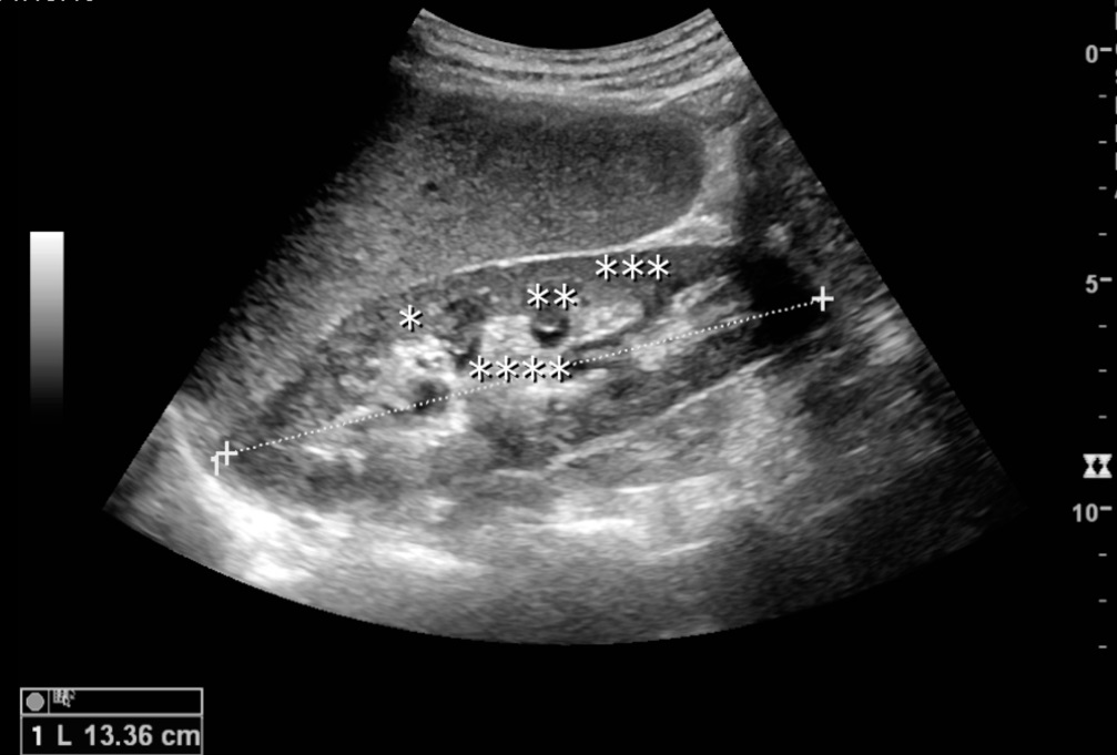 Normal adult kidney on ultrasound. Original source labels: * column of Bertin, ** pyramid, *** cortex, **** sinus; the dashed line measures renal length.